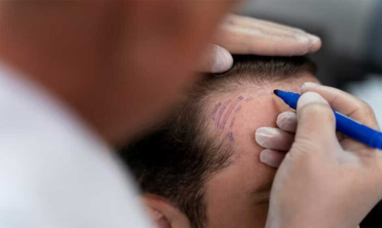 How-Long-Results-Last-from-FUE-and-Strip-Hair-Transplants